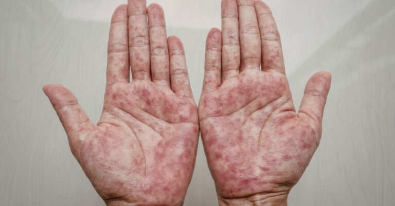 Psoriase