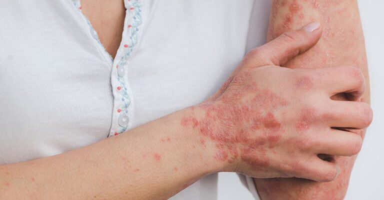 Protocolo para Psoriase